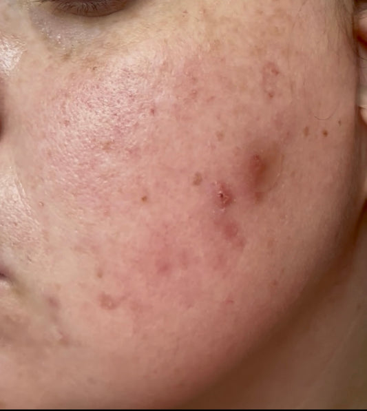 Slique Hydrocolloid Pimple Patches